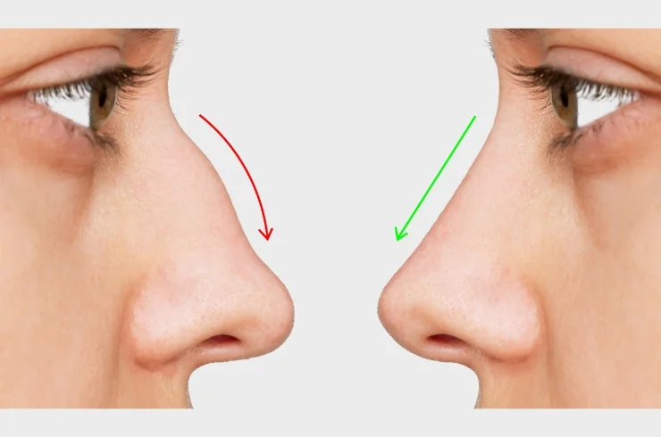 Open and Closed Rhinoplasty ---4